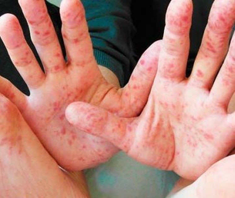 У Польщі стався спалах кору: вже перехворіло 35 тисяч людей